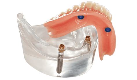 over denture insert replacement